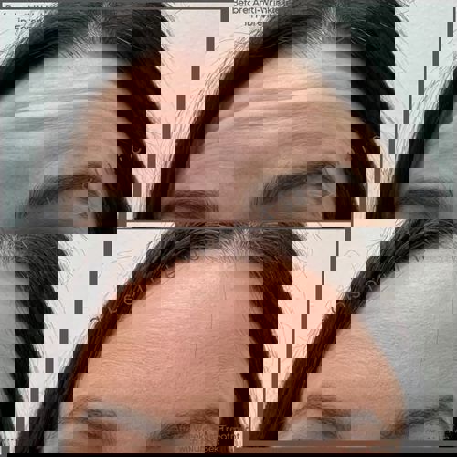 Anti-Wrinkle Injections