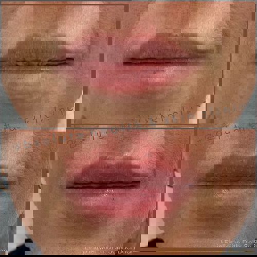 Dermal Filler
